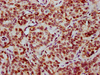 IHC image of CSB-PA010403OA12nbutHU diluted at 1:20 and staining in paraffin-embedded human liver cancer performed on a Leica BondTM system. After dewaxing and hydration, antigen retrieval was mediated by high pressure in a citrate buffer (pH 6.0)...