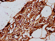 IHC image of CSB-PA010403OA15nme1HU diluted at 1:20 and staining in paraffin-embedded human breast cancer performed on a Leica BondTM system. After dewaxing and hydration, antigen retrieval was mediated by high pressure in a citrate buffer (pH 6.0...