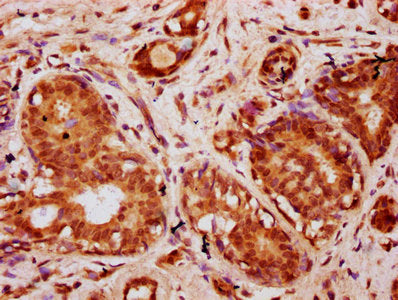 IHC image of CSB-PA010403OA20nbhbHU diluted at 1:10 and staining in paraffin-embedded human breast cancer performed on a Leica BondTM system. After dewaxing and hydration, antigen retrieval was mediated by high pressure in a citrate buffer (pH 6.0...