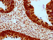 IHC image of CSB-PA010403OA23ncrHU diluted at 1:10 and staining in paraffin-embedded human ovarian cancer performed on a Leica BondTM system. After dewaxing and hydration, antigen retrieval was mediated by high pressure in a citrate buffer (pH 6.0...