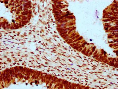 IHC image of CSB-PA010403OA23ncrHU diluted at 1:10 and staining in paraffin-embedded human ovarian cancer performed on a Leica BondTM system. After dewaxing and hydration, antigen retrieval was mediated by high pressure in a citrate buffer (pH 6.0...
