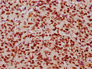 IHC image of CSB-PA010403OA23nhibHU diluted at 1:10 and staining in paraffin-embedded human glioma performed on a Leica BondTM system. After dewaxing and hydration, antigen retrieval was mediated by high pressure in a citrate buffer (pH 6.0). Sect...