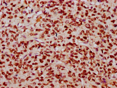 IHC image of CSB-PA010403OA23nhibHU diluted at 1:10 and staining in paraffin-embedded human glioma performed on a Leica BondTM system. After dewaxing and hydration, antigen retrieval was mediated by high pressure in a citrate buffer (pH 6.0). Sect...