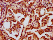 IHC image of CSB-PA010403OA34ncrHU diluted at 1:10 and staining in paraffin-embedded human lung cancer performed on a Leica BondTM system. After dewaxing and hydration, antigen retrieval was mediated by high pressure in a citrate buffer (pH 6.0)....