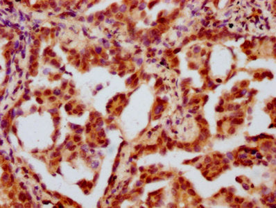IHC image of CSB-PA010403OA34ncrHU diluted at 1:10 and staining in paraffin-embedded human lung cancer performed on a Leica BondTM system. After dewaxing and hydration, antigen retrieval was mediated by high pressure in a citrate buffer (pH 6.0)....