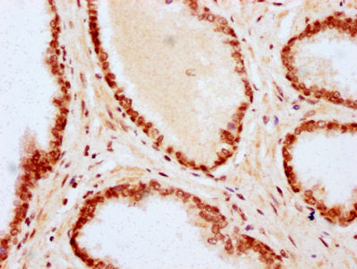 IHC image of CSB-PA010403OA79nme1HU diluted at 1:20 and staining in paraffin-embedded human prostate cancer performed on a Leica BondTM system. After dewaxing and hydration, antigen retrieval was mediated by high pressure in a citrate buffer (pH 6...