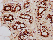 IHC image of CSB-PA010403OA85nacHU diluted at 1:20 and staining in paraffin-embedded human breast cancer performed on a Leica BondTM system. After dewaxing and hydration, antigen retrieval was mediated by high pressure in a citrate buffer (pH 6.0)...