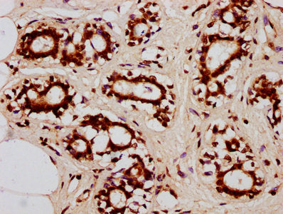 IHC image of CSB-PA010403OA85nacHU diluted at 1:20 and staining in paraffin-embedded human breast cancer performed on a Leica BondTM system. After dewaxing and hydration, antigen retrieval was mediated by high pressure in a citrate buffer (pH 6.0)...