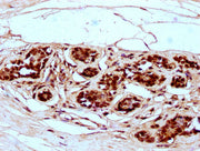 IHC image of CSB-PA010403OA99nme1HU diluted at 1:5 and staining in paraffin-embedded human breast cancer performed on a Leica BondTM system. After dewaxing and hydration, antigen retrieval was mediated by high pressure in a citrate buffer (pH 6.0)...