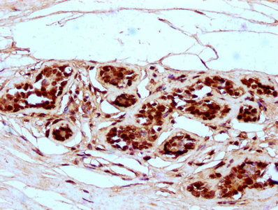 IHC image of CSB-PA010403OA99nme1HU diluted at 1:5 and staining in paraffin-embedded human breast cancer performed on a Leica BondTM system. After dewaxing and hydration, antigen retrieval was mediated by high pressure in a citrate buffer (pH 6.0)...