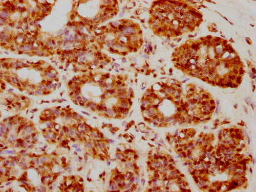 IHC image of CSB-PA010403PA05nforHU diluted at 1:20 and staining in paraffin-embedded human breast cancer performed on a Leica BondTM system. After dewaxing and hydration, antigen retrieval was mediated by high pressure in a citrate buffer (pH 6.0...
