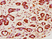 IHC image of CSB-PA010403PA120nsucHU diluted at 1:10 and staining in paraffin-embedded human breast cancer performed on a Leica BondTM system. After dewaxing and hydration, antigen retrieval was mediated by high pressure in a citrate buffer (pH 6....