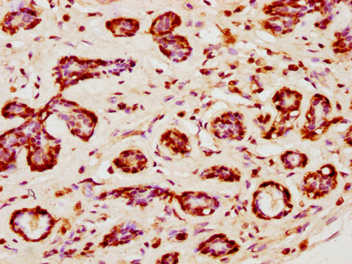 IHC image of CSB-PA010403PA120nsucHU diluted at 1:10 and staining in paraffin-embedded human breast cancer performed on a Leica BondTM system. After dewaxing and hydration, antigen retrieval was mediated by high pressure in a citrate buffer (pH 6....