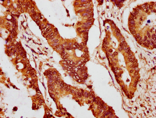 IHC image of CSB-PA010403PA15nme1HU diluted at 1:10 and staining in paraffin-embedded human colon cancer performed on a Leica BondTM system. After dewaxing and hydration, antigen retrieval was mediated by high pressure in a citrate buffer (pH 6.0)...