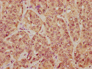 IHC image of CSB-PA010403PA23nme1HU diluted at 1:20 and staining in paraffin-embedded human liver cancer performed on a Leica BondTM system. After dewaxing and hydration, antigen retrieval was mediated by high pressure in a citrate buffer (pH 6.0)...