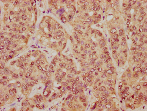 IHC image of CSB-PA010403PA23nme1HU diluted at 1:20 and staining in paraffin-embedded human liver cancer performed on a Leica BondTM system. After dewaxing and hydration, antigen retrieval was mediated by high pressure in a citrate buffer (pH 6.0)...