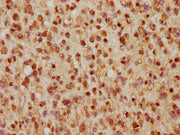 IHC image of CSB-PA010403PA57nhibHU diluted at 1:5 and staining in paraffin-embedded human glioma cancer performed on a Leica BondTM system. After dewaxing and hydration, antigen retrieval was mediated by high pressure in a citrate buffer (pH 6.0)...
