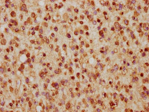 IHC image of CSB-PA010403PA57nhibHU diluted at 1:5 and staining in paraffin-embedded human glioma cancer performed on a Leica BondTM system. After dewaxing and hydration, antigen retrieval was mediated by high pressure in a citrate buffer (pH 6.0)...