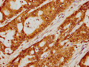 IHC image of CSB-PA010403PA79nme1HU diluted at 1:5 and staining in paraffin-embedded human colon cancer performed on a Leica BondTM system. After dewaxing and hydration, antigen retrieval was mediated by high pressure in a citrate buffer (pH 6.0)....