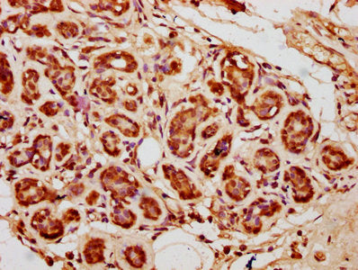 IHC image of CSB-PA010418OA04nbhbHU diluted at 1:10 and staining in paraffin-embedded human breast cancer performed on a Leica BondTM system. After dewaxing and hydration, antigen retrieval was mediated by high pressure in a citrate buffer (pH 6.0...