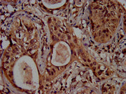 IHC image of CSB-PA010418OA04ncrHU diluted at 1:100 and staining in paraffin-embedded human cervical cancer performed on a Leica BondTM system. After dewaxing and hydration, antigen retrieval was mediated by high pressure in a citrate buffer (pH 6...