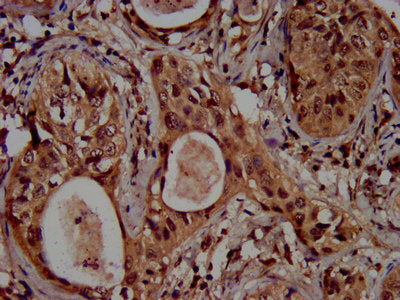IHC image of CSB-PA010418OA04ncrHU diluted at 1:100 and staining in paraffin-embedded human cervical cancer performed on a Leica BondTM system. After dewaxing and hydration, antigen retrieval was mediated by high pressure in a citrate buffer (pH 6...