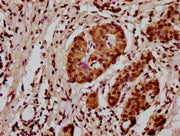 IHC image of CSB-PA010418OA128nme1HU diluted at 1:20 and staining in paraffin-embedded human pancreatic cancer performed on a Leica BondTM system. After dewaxing and hydration, antigen retrieval was mediated by high pressure in a citrate buffer (p...