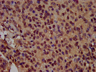 IHC image of CSB-PA010418OA14nsucHU diluted at 1:100 and staining in paraffin-embedded human glioma performed on a Leica BondTM system. After dewaxing and hydration, antigen retrieval was mediated by high pressure in a citrate buffer (pH 6.0). Sec...