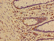 Immunohistochemistry of paraffin-embedded human colon cancer using CSB-PA010418OA17nme2HU at dilution of 1:100