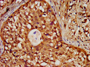IHC image of CSB-PA010418OA18nforHU diluted at 1:30 and staining in paraffin-embedded human colon cancer performed on a Leica BondTM system. After dewaxing and hydration, antigen retrieval was mediated by high pressure in a citrate buffer (pH 6.0)...