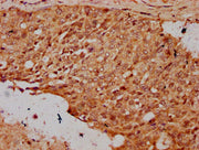 IHC image of CSB-PA010418OA23nsucHU diluted at 1:20 and staining in paraffin-embedded human cervical cancer performed on a Leica BondTM system. After dewaxing and hydration, antigen retrieval was mediated by high pressure in a citrate buffer (pH 6...