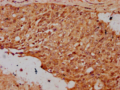 IHC image of CSB-PA010418OA23nsucHU diluted at 1:20 and staining in paraffin-embedded human cervical cancer performed on a Leica BondTM system. After dewaxing and hydration, antigen retrieval was mediated by high pressure in a citrate buffer (pH 6...
