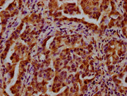 IHC image of CSB-PA010418OA27nbhbHU diluted at 1:20 and staining in paraffin-embedded human lung cancer performed on a Leica BondTM system. After dewaxing and hydration, antigen retrieval was mediated by high pressure in a citrate buffer (pH 6.0)....