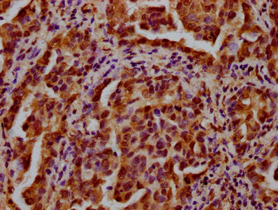 IHC image of CSB-PA010418OA27nbhbHU diluted at 1:20 and staining in paraffin-embedded human lung cancer performed on a Leica BondTM system. After dewaxing and hydration, antigen retrieval was mediated by high pressure in a citrate buffer (pH 6.0)....