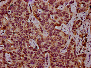 IHC image of CSB-PA010418OA27nhibHU diluted at 1:10 and staining in paraffin-embedded human liver cancer performed on a Leica BondTM system. After dewaxing and hydration, antigen retrieval was mediated by high pressure in a citrate buffer (pH 6.0)...