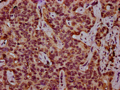 IHC image of CSB-PA010418OA27nhibHU diluted at 1:10 and staining in paraffin-embedded human liver cancer performed on a Leica BondTM system. After dewaxing and hydration, antigen retrieval was mediated by high pressure in a citrate buffer (pH 6.0)...