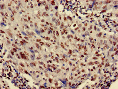 Immunohistochemistry of paraffin-embedded human lung cancer using CSB-PA010418OA27nme1HU at dilution of 1:100