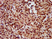 IHC image of CSB-PA010418OA56nhibHU diluted at 1: 10 and staining in paraffin-embedded human ovarian cancer performed on a Leica BondTM system. After dewaxing and hydration, antigen retrieval was mediated by high pressure in a citrate buffer (pH 6...