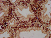 IHC image of CSB-PA010418OA64nacHU diluted at 1:100 and staining in paraffin-embedded human prostate cancer performed on a Leica BondTM system. After dewaxing and hydration, antigen retrieval was mediated by high pressure in a citrate buffer (pH 6...