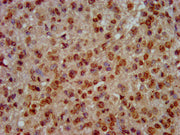 IHC image of CSB-PA010418OA64nforHU diluted at 1:30 and staining in paraffin-embedded human glioma performed on a Leica BondTM system. After dewaxing and hydration, antigen retrieval was mediated by high pressure in a citrate buffer (pH 6.0). Sect...