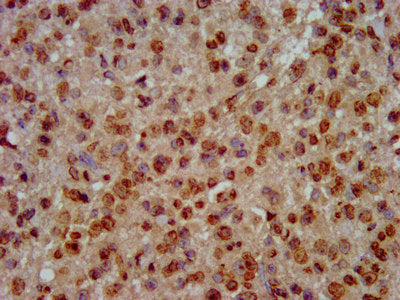 IHC image of CSB-PA010418OA64nforHU diluted at 1:30 and staining in paraffin-embedded human glioma performed on a Leica BondTM system. After dewaxing and hydration, antigen retrieval was mediated by high pressure in a citrate buffer (pH 6.0). Sect...