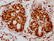 IHC image of CSB-PA010418PA115nacHU diluted at 1:10 and staining in paraffin-embedded human breast cancer performed on a Leica BondTM system. After dewaxing and hydration, antigen retrieval was mediated by high pressure in a citrate buffer (pH 6.0...