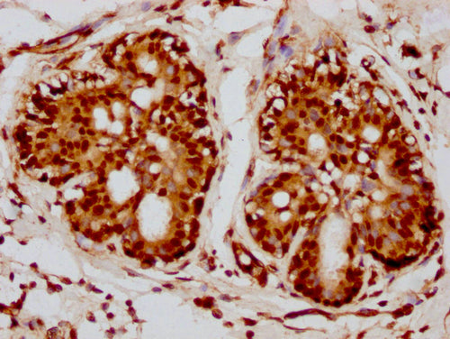 IHC image of CSB-PA010418PA115nacHU diluted at 1:10 and staining in paraffin-embedded human breast cancer performed on a Leica BondTM system. After dewaxing and hydration, antigen retrieval was mediated by high pressure in a citrate buffer (pH 6.0...