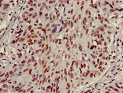 Immunohistochemistry of paraffin-embedded human lung cancer using CSB-PA010418PA27nme2HU at dilution of 1:100