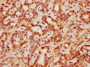 IHC image of CSB-PA010418PA41nphHU diluted at 1:20 and staining in paraffin-embedded human liver cancer performed on a Leica BondTM system. After dewaxing and hydration, antigen retrieval was mediated by high pressure in a citrate buffer (pH 6.0)....
