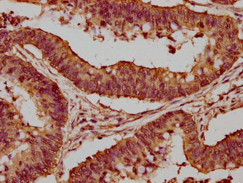 IHC image of CSB-PA010418PA56nme1HU diluted at 1:20 and staining in paraffin-embedded human colon cancer performed on a Leica BondTM system. After dewaxing and hydration, antigen retrieval was mediated by high pressure in a citrate buffer (pH 6.0)...