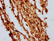 IHC image of CSB-PA010429OA05nbhbHU diluted at 1:10 and staining in paraffin-embedded human melanoma performed on a Leica BondTM system. After dewaxing and hydration, antigen retrieval was mediated by high pressure in a citrate buffer (pH 6.0). Se...