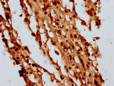 IHC image of CSB-PA010429OA05nbhbHU diluted at 1:10 and staining in paraffin-embedded human melanoma performed on a Leica BondTM system. After dewaxing and hydration, antigen retrieval was mediated by high pressure in a citrate buffer (pH 6.0). Se...