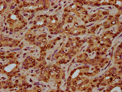IHC image of CSB-PA010429OA05nhibHU diluted at 1:3 and staining in paraffin-embedded human liver cancer performed on a Leica BondTM system. After dewaxing and hydration, antigen retrieval was mediated by high pressure in a citrate buffer (pH 6.0)....
