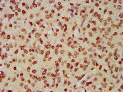 IHC image of CSB-PA010429OA12nbioHU diluted at 1:1 and staining in paraffin-embedded human glioma performed on a Leica BondTM system. After dewaxing and hydration, antigen retrieval was mediated by high pressure in a citrate buffer (pH 6.0). Secti...